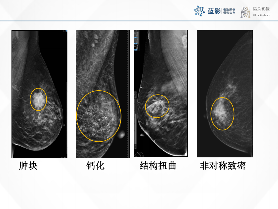 影像PPT - 【PPT】乳腺X线摄影在乳腺癌早筛早诊中的应用价值-45