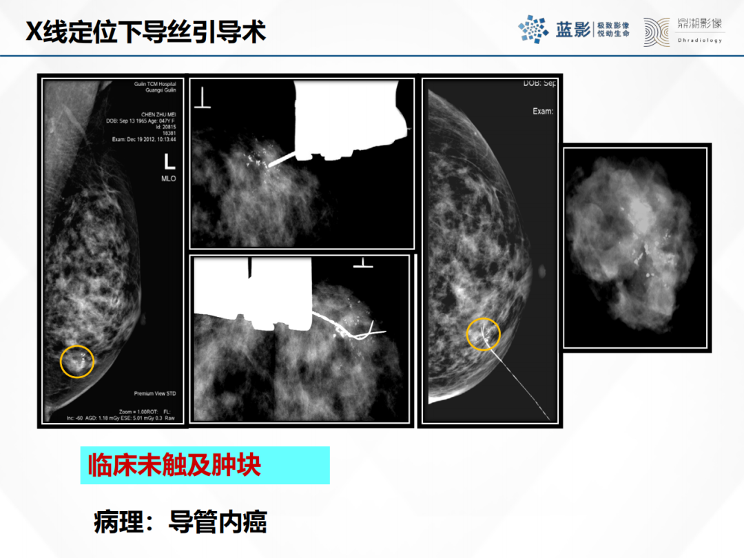 影像PPT - 【PPT】乳腺X线摄影在乳腺癌早筛早诊中的应用价值-40