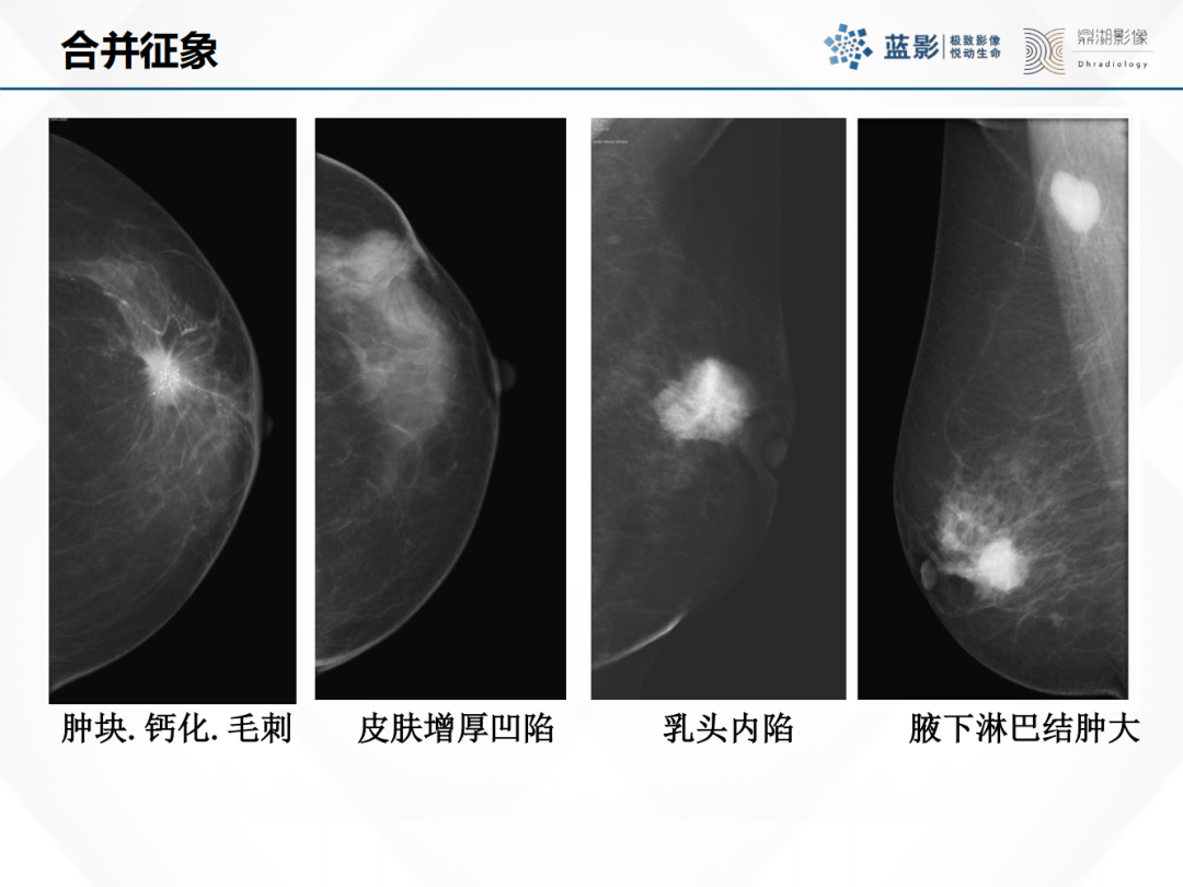 影像PPT - 【PPT】乳腺X线摄影在乳腺癌早筛早诊中的应用价值-47