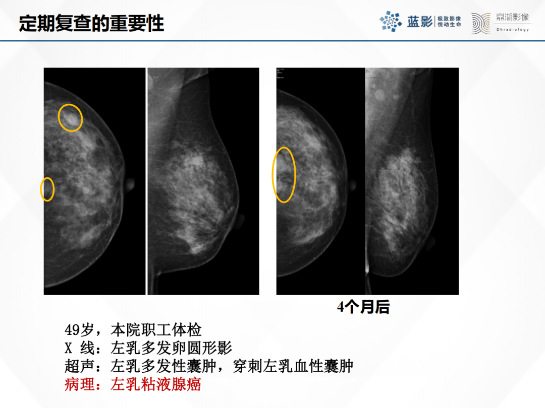 影像PPT - 【PPT】乳腺X线摄影在乳腺癌早筛早诊中的应用价值-54