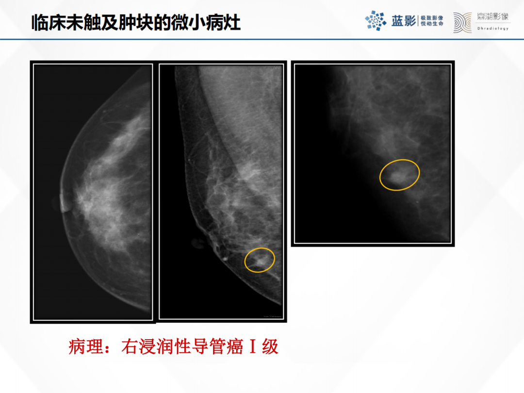 影像PPT - 【PPT】乳腺X线摄影在乳腺癌早筛早诊中的应用价值-52
