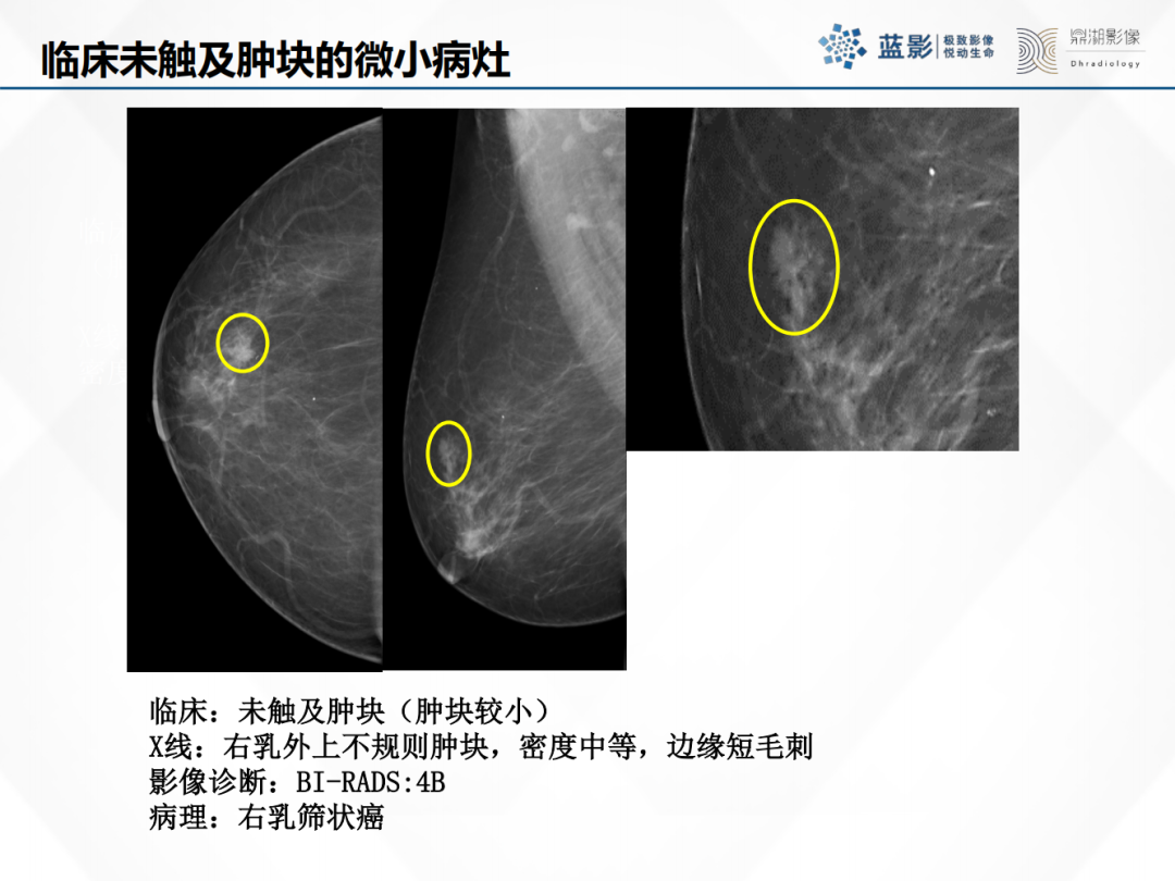 影像PPT - 【PPT】乳腺X线摄影在乳腺癌早筛早诊中的应用价值-51