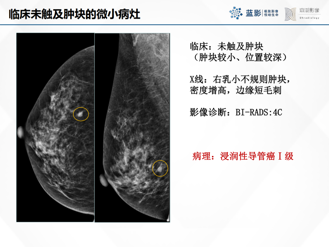 影像PPT - 【PPT】乳腺X线摄影在乳腺癌早筛早诊中的应用价值-50