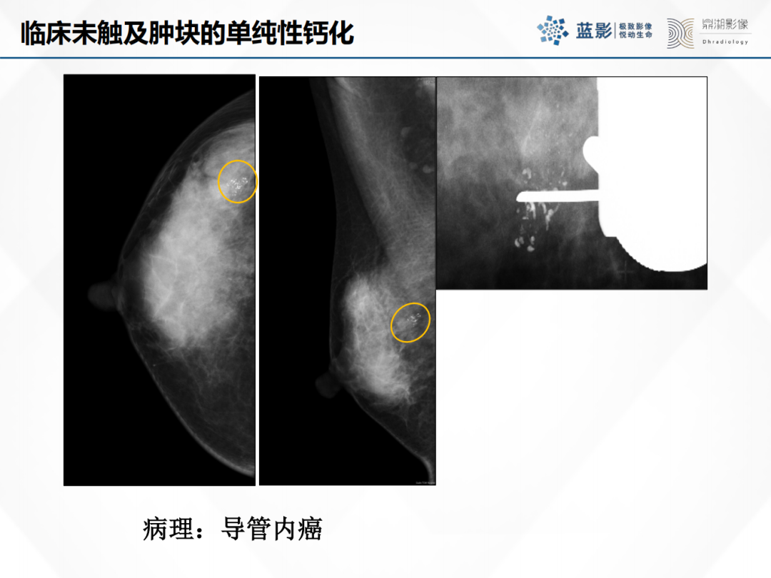 影像PPT - 【PPT】乳腺X线摄影在乳腺癌早筛早诊中的应用价值-49