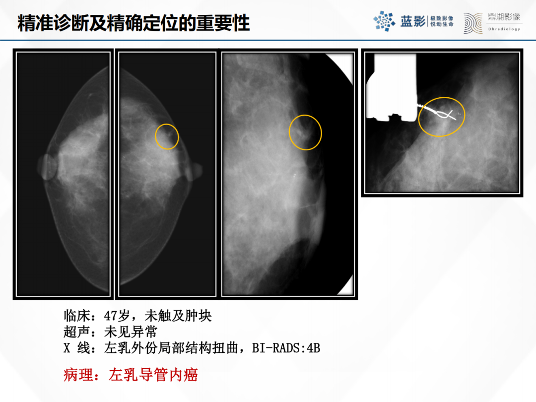 影像PPT - 【PPT】乳腺X线摄影在乳腺癌早筛早诊中的应用价值-53
