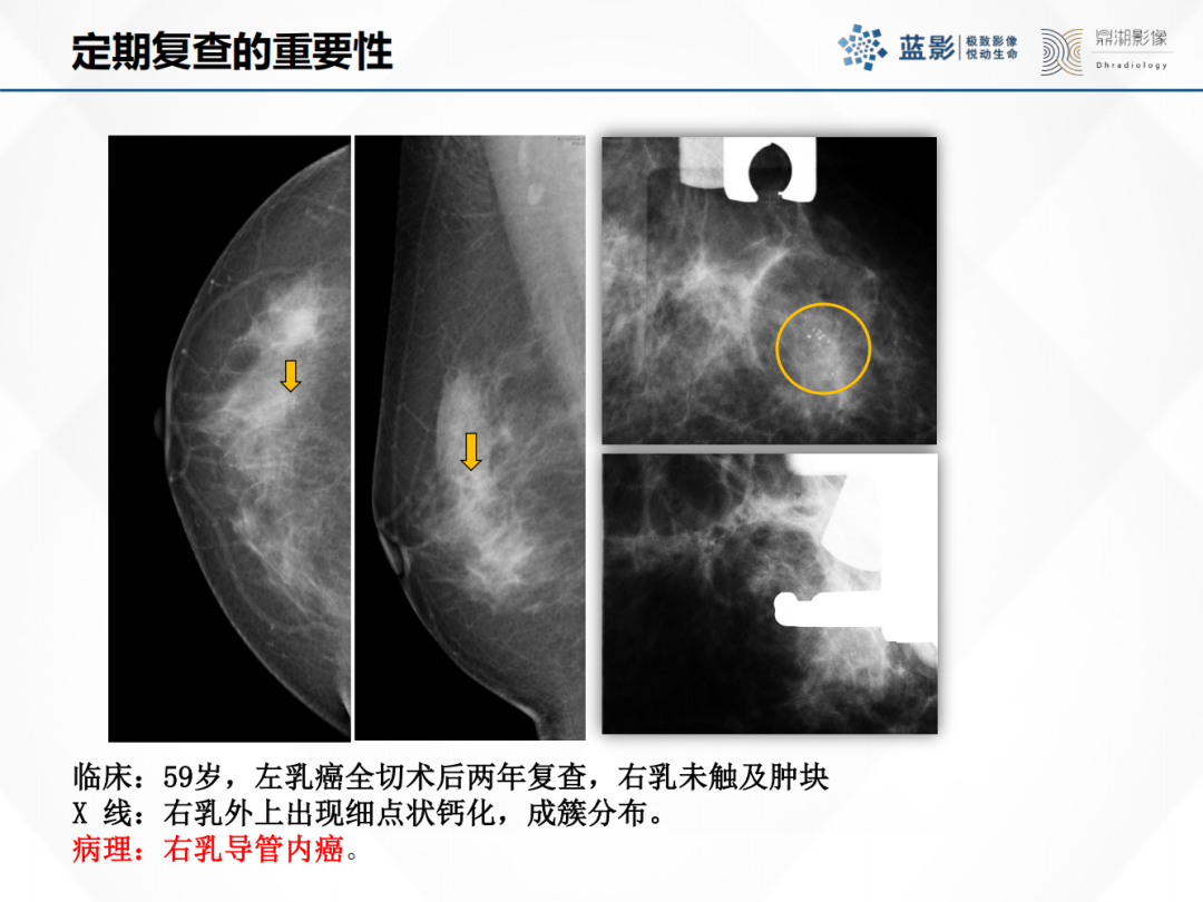 影像PPT - 【PPT】乳腺X线摄影在乳腺癌早筛早诊中的应用价值-56