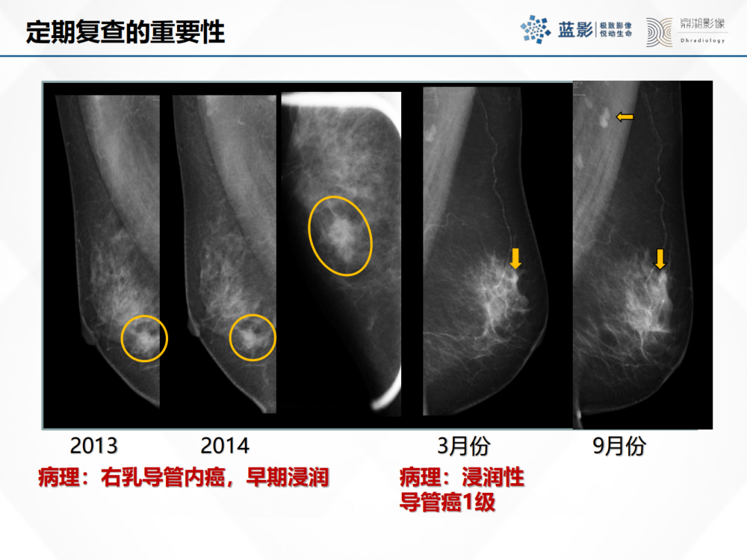 影像PPT - 【PPT】乳腺X线摄影在乳腺癌早筛早诊中的应用价值-55