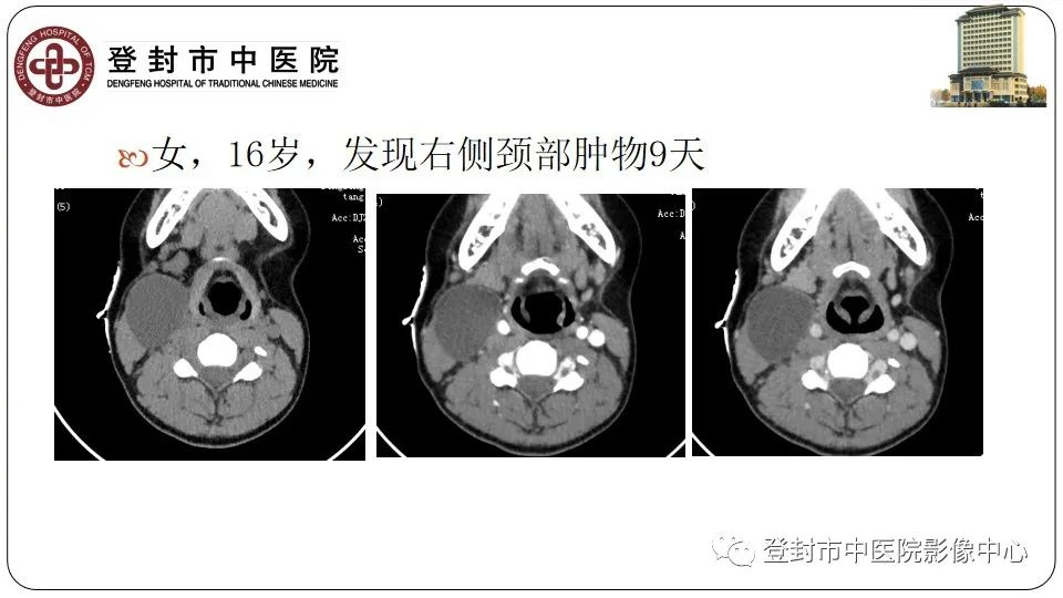影像PPT - 【PPT】颈部先天性囊性病变-21