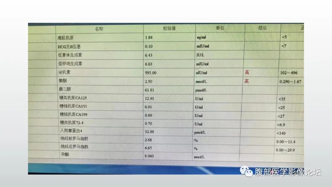 影像PPT - 【PPT】卵巢性索间质肿瘤—低分化Sertoli-Leydig细胞瘤1例MR影像-6 影像PPT - 【PPT】卵巢性索间质肿瘤—低分化Sertoli-Leydig细胞瘤1例MR影像-6