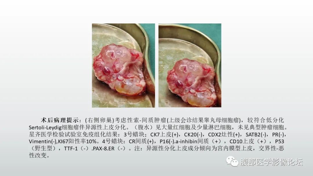 影像PPT - 【PPT】卵巢性索间质肿瘤—低分化Sertoli-Leydig细胞瘤1例MR影像-13 影像PPT - 【PPT】卵巢性索间质肿瘤—低分化Sertoli-Leydig细胞瘤1例MR影像-13