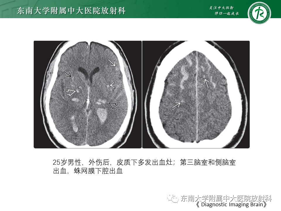 影像PPT - 【PPT】弥漫性轴索损伤-22