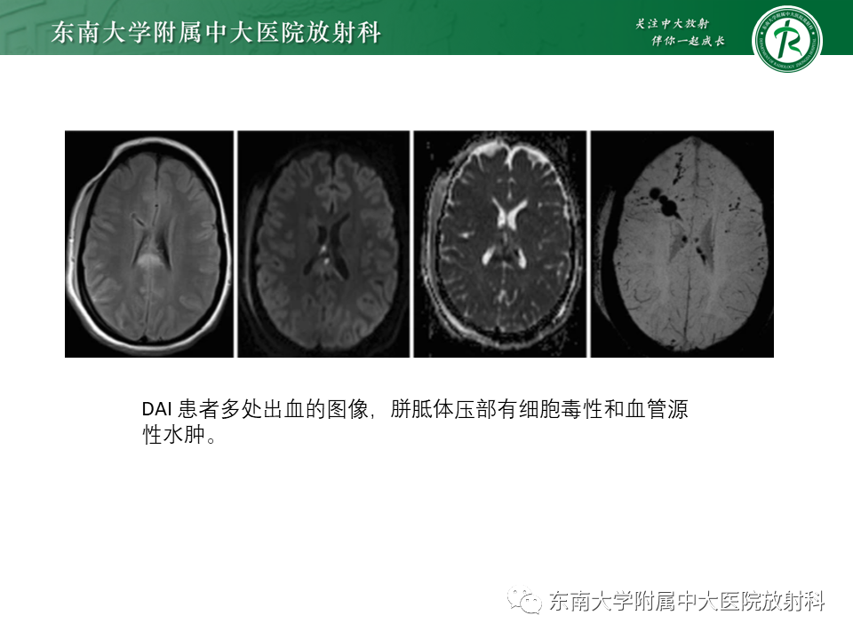 影像PPT - 【PPT】弥漫性轴索损伤-25