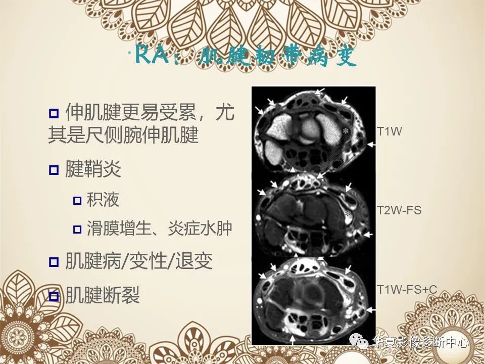 影像PPT - 【PPT】类风湿性关节炎的早期影像学诊断-14