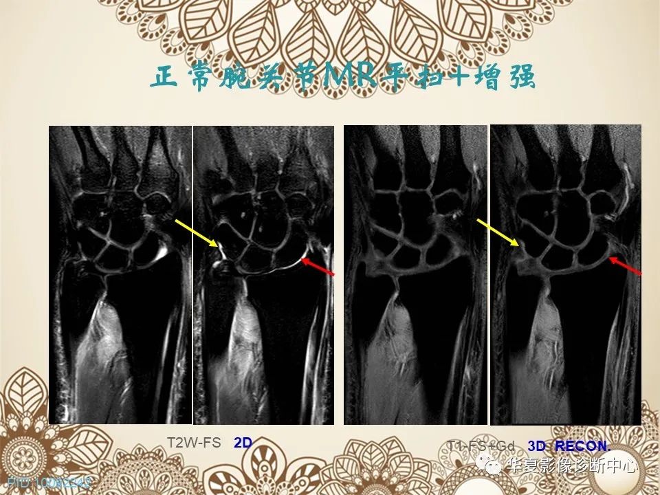 影像PPT - 【PPT】类风湿性关节炎的早期影像学诊断-11