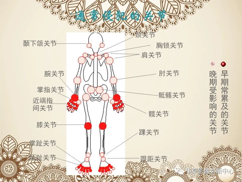 影像PPT - 【PPT】类风湿性关节炎的早期影像学诊断-7