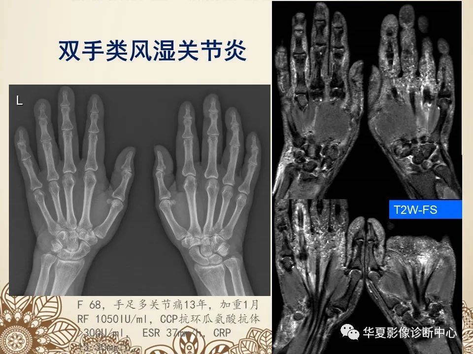 影像PPT - 【PPT】类风湿性关节炎的早期影像学诊断-20