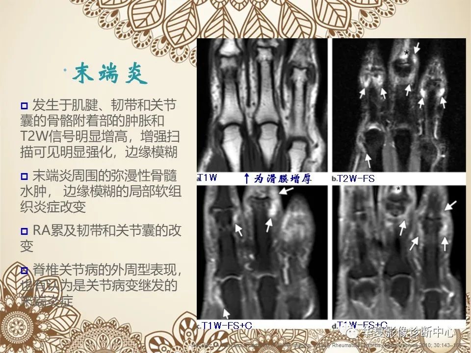 影像PPT - 【PPT】类风湿性关节炎的早期影像学诊断-15