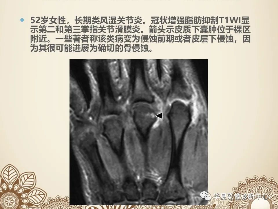 影像PPT - 【PPT】类风湿性关节炎的早期影像学诊断-12