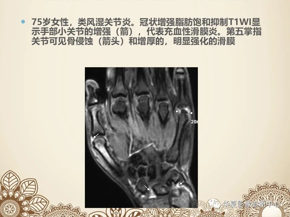 影像PPT - 【PPT】类风湿性关节炎的早期影像学诊断-13