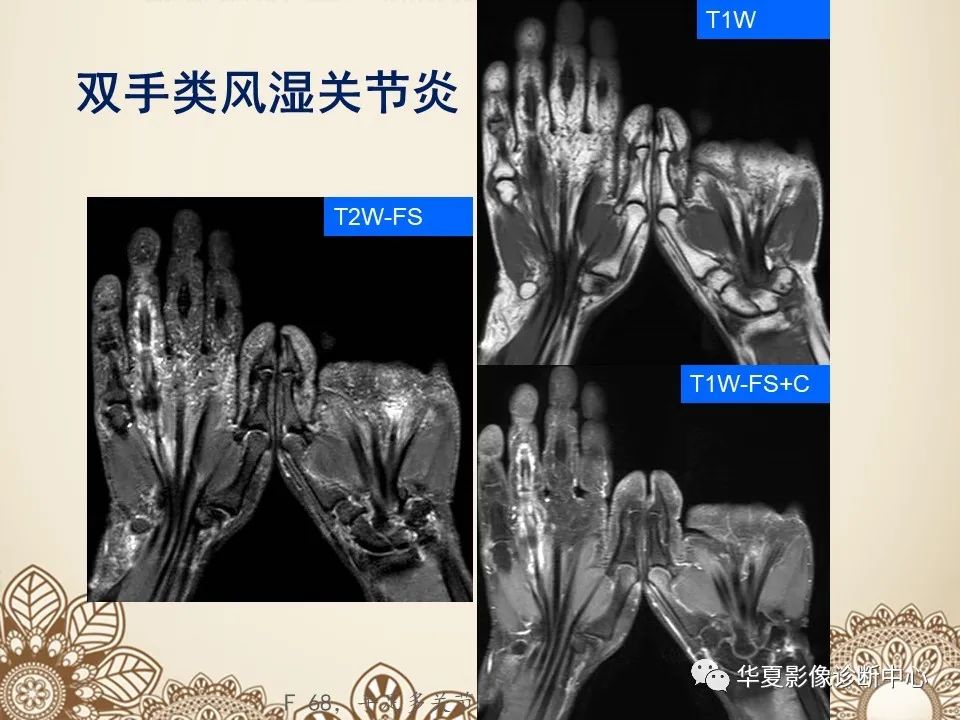 影像PPT - 【PPT】类风湿性关节炎的早期影像学诊断-22
