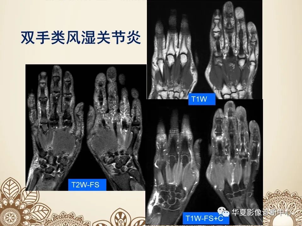 影像PPT - 【PPT】类风湿性关节炎的早期影像学诊断-21