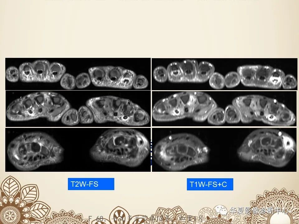 影像PPT - 【PPT】类风湿性关节炎的早期影像学诊断-23