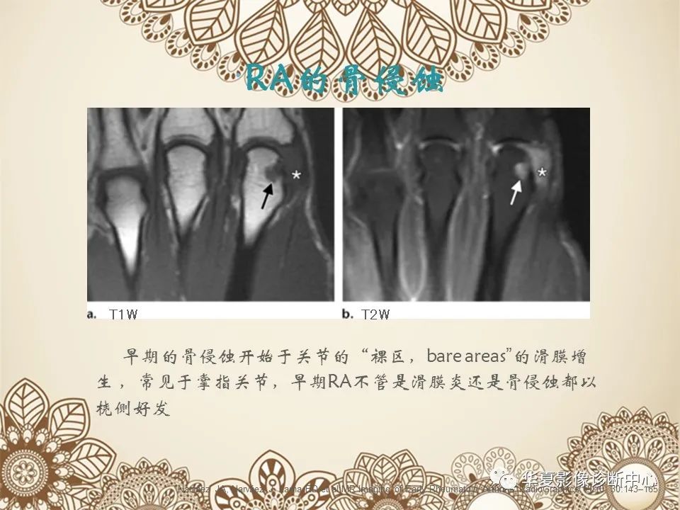 影像PPT - 【PPT】类风湿性关节炎的早期影像学诊断-24