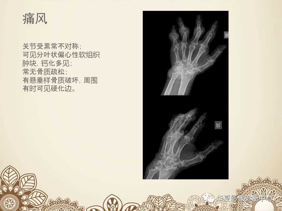 影像PPT - 【PPT】类风湿性关节炎的早期影像学诊断-28