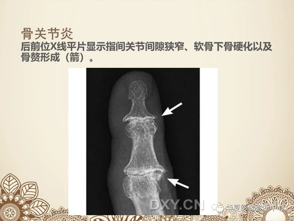 影像PPT - 【PPT】类风湿性关节炎的早期影像学诊断-27
