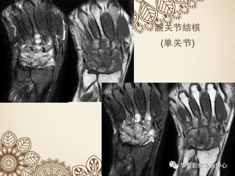 影像PPT - 【PPT】类风湿性关节炎的早期影像学诊断-29