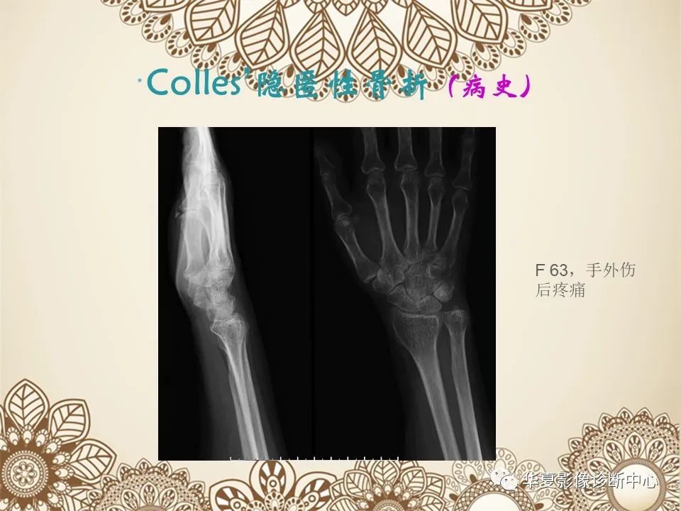 影像PPT - 【PPT】类风湿性关节炎的早期影像学诊断-30