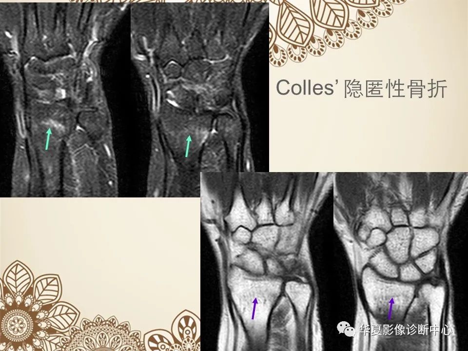 影像PPT - 【PPT】类风湿性关节炎的早期影像学诊断-31