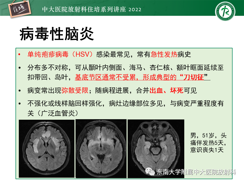 影像PPT - 【PPT】边缘系统受累疾病影像诊断与鉴别-10
