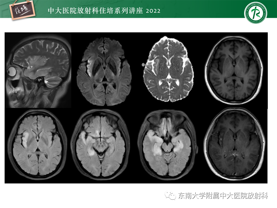 影像PPT - 【PPT】边缘系统受累疾病影像诊断与鉴别-8