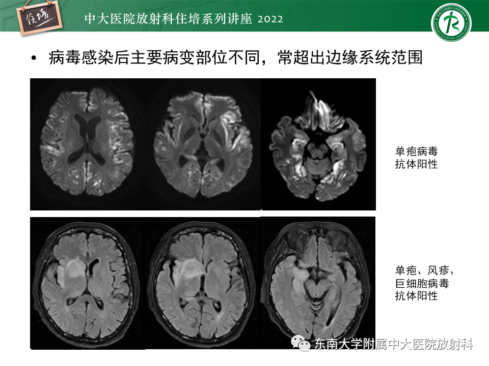 影像PPT - 【PPT】边缘系统受累疾病影像诊断与鉴别-12