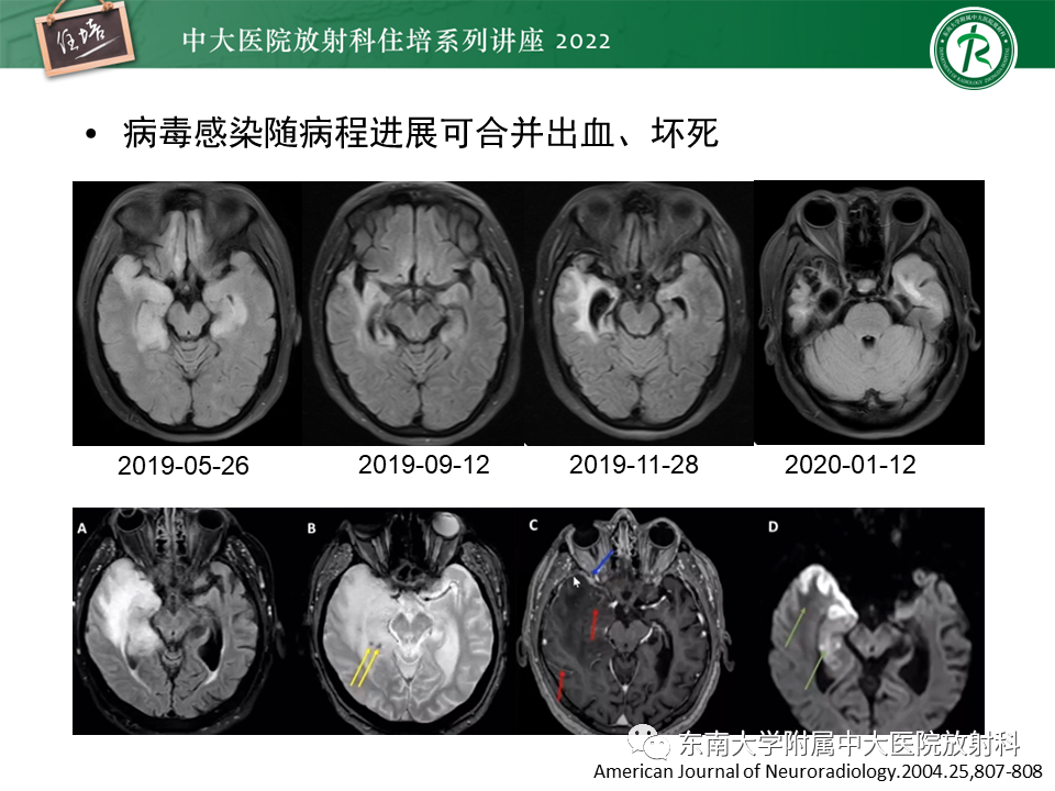 影像PPT - 【PPT】边缘系统受累疾病影像诊断与鉴别-11