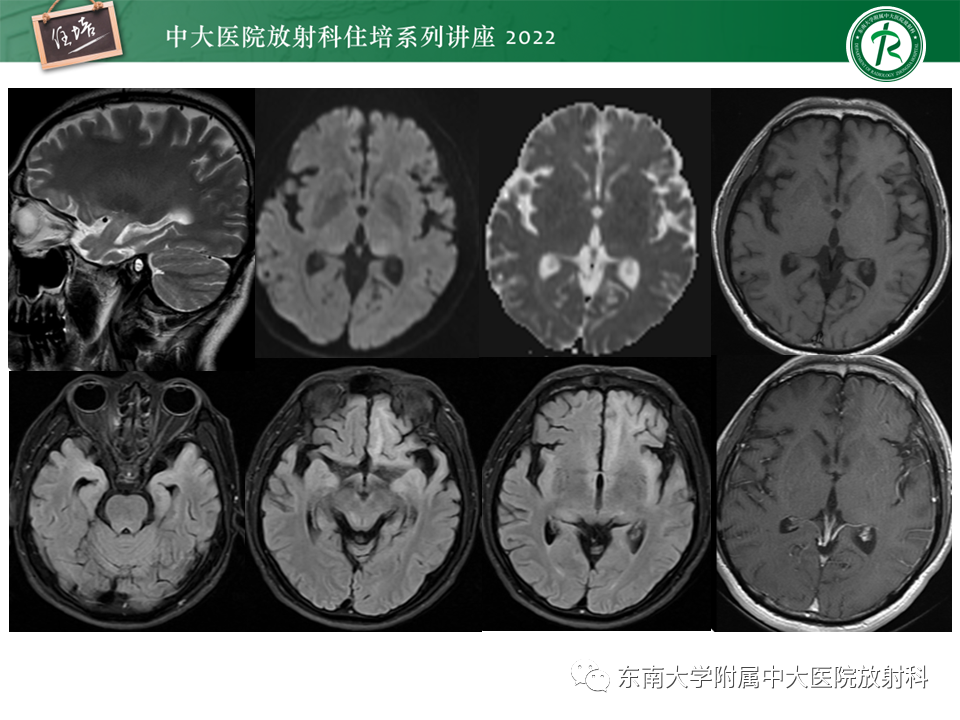 影像PPT - 【PPT】边缘系统受累疾病影像诊断与鉴别-14