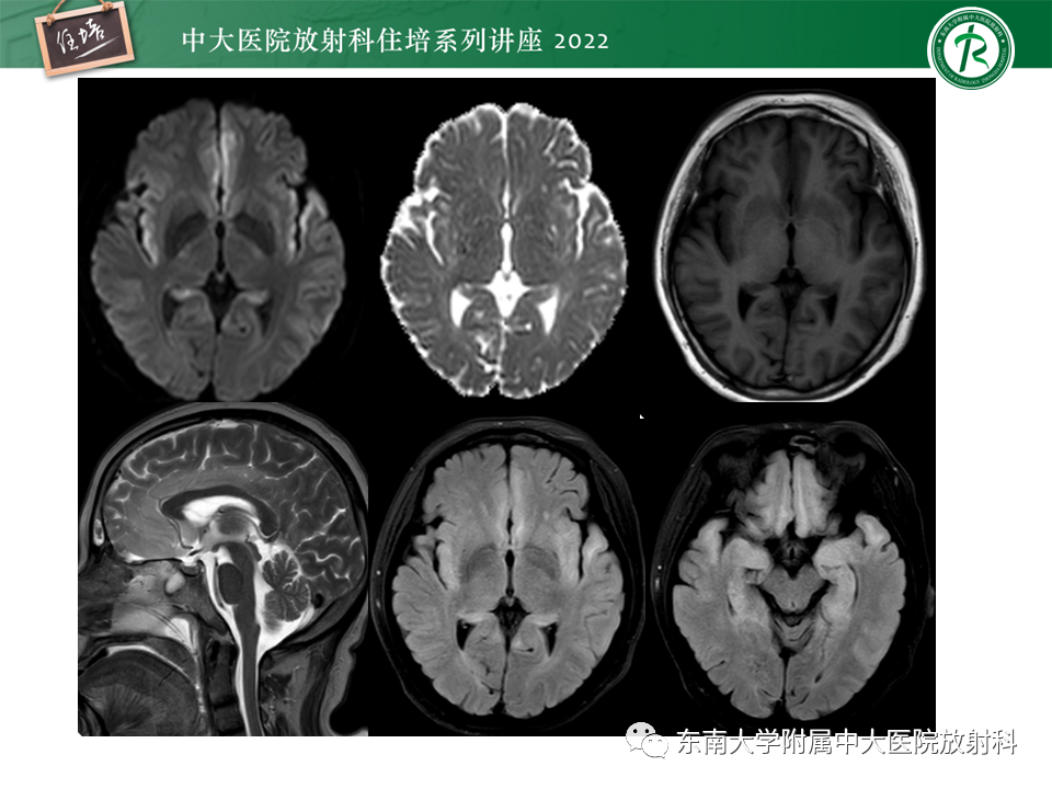影像PPT - 【PPT】边缘系统受累疾病影像诊断与鉴别-26