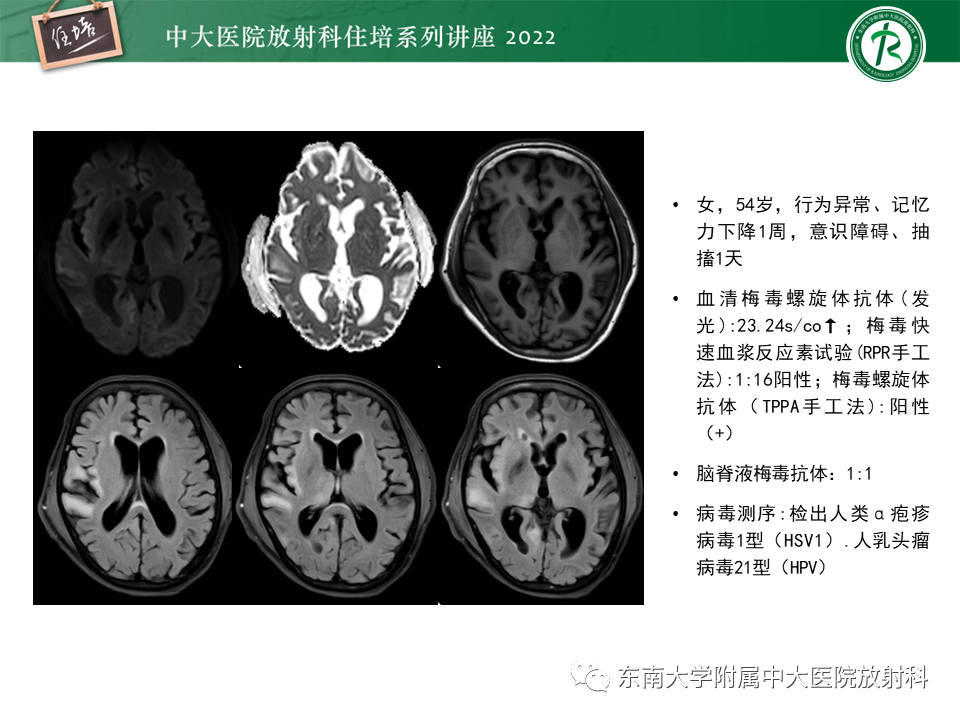 影像PPT - 【PPT】边缘系统受累疾病影像诊断与鉴别-17