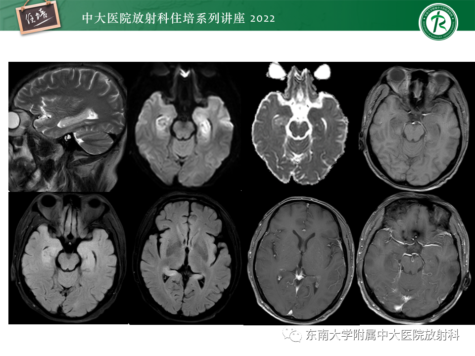 影像PPT - 【PPT】边缘系统受累疾病影像诊断与鉴别-19