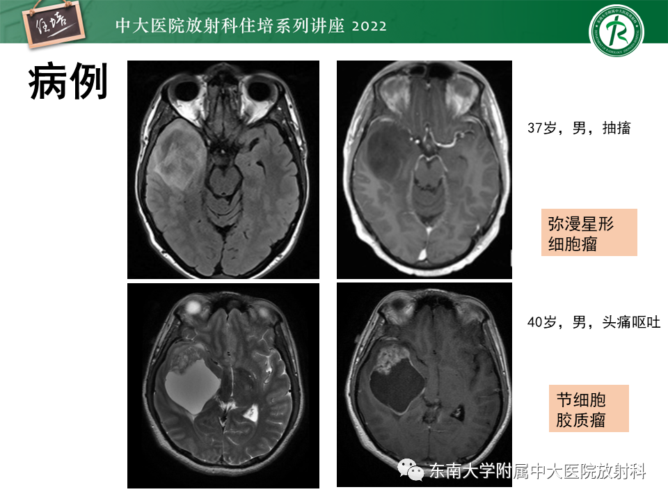 影像PPT - 【PPT】边缘系统受累疾病影像诊断与鉴别-31