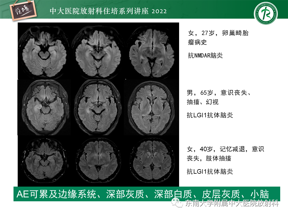 影像PPT - 【PPT】边缘系统受累疾病影像诊断与鉴别-24