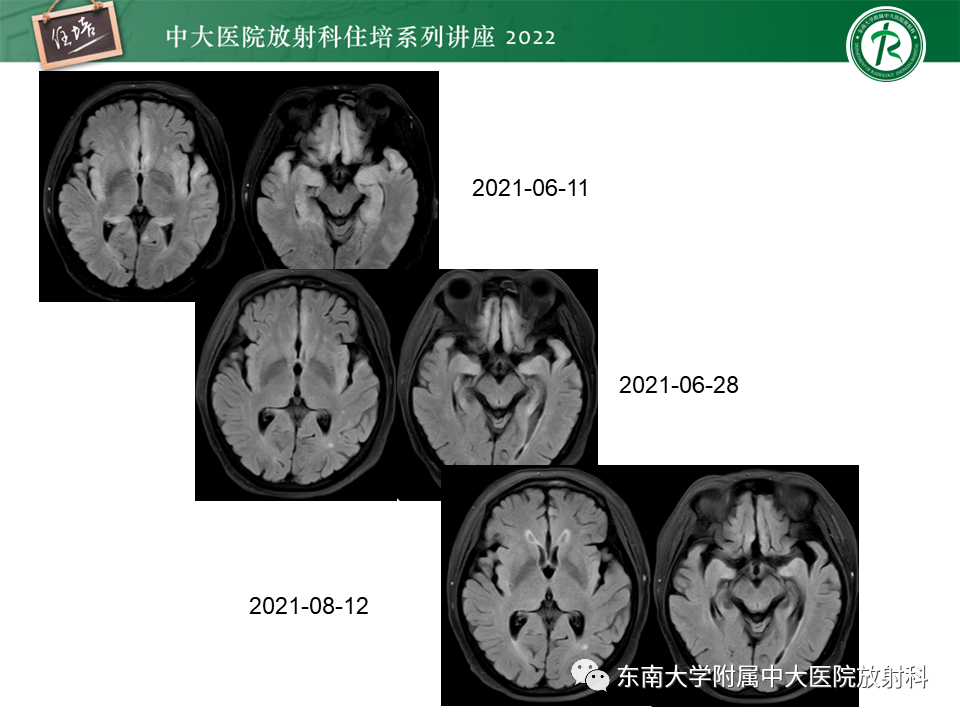 影像PPT - 【PPT】边缘系统受累疾病影像诊断与鉴别-28