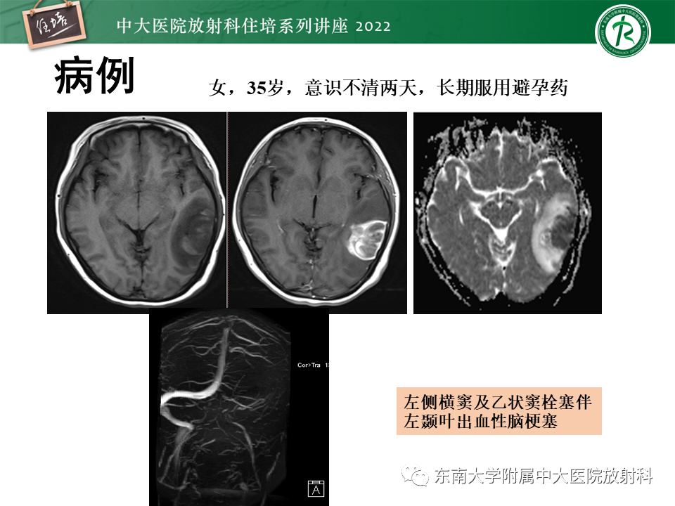 影像PPT - 【PPT】边缘系统受累疾病影像诊断与鉴别-35