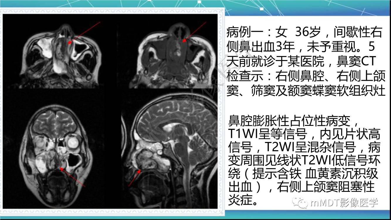 影像PPT - 【PPT】出血坏死性鼻息肉CT/MRI诊断-2