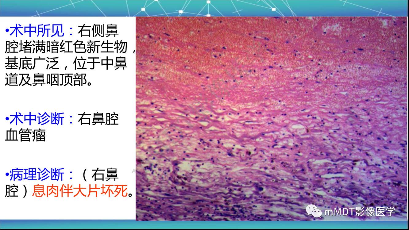 影像PPT - 【PPT】出血坏死性鼻息肉CT/MRI诊断-3