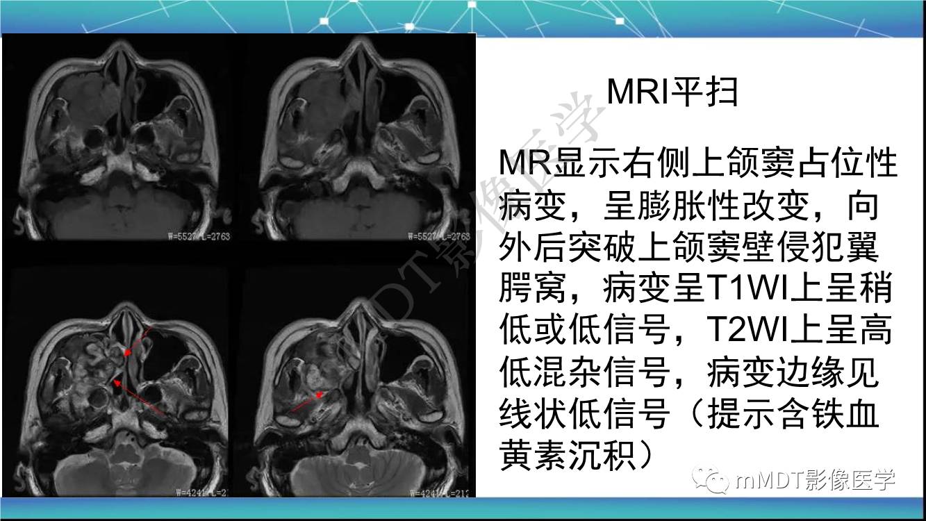 影像PPT - 【PPT】出血坏死性鼻息肉CT/MRI诊断-10