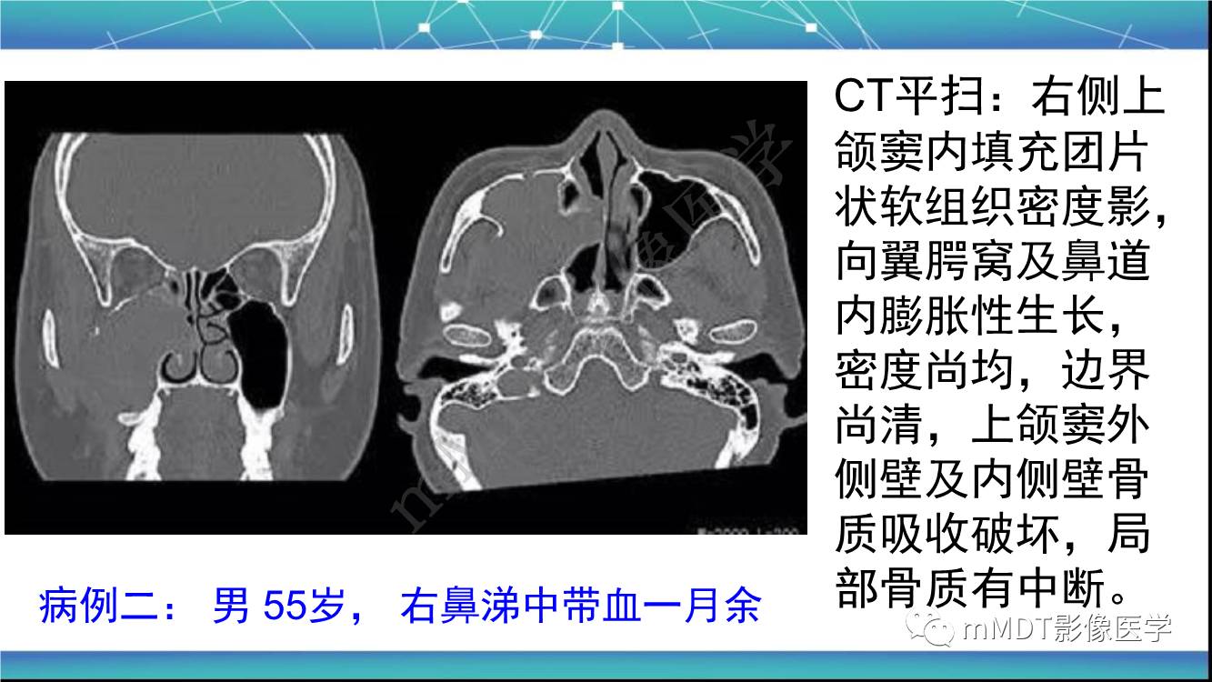 影像PPT - 【PPT】出血坏死性鼻息肉CT/MRI诊断-9