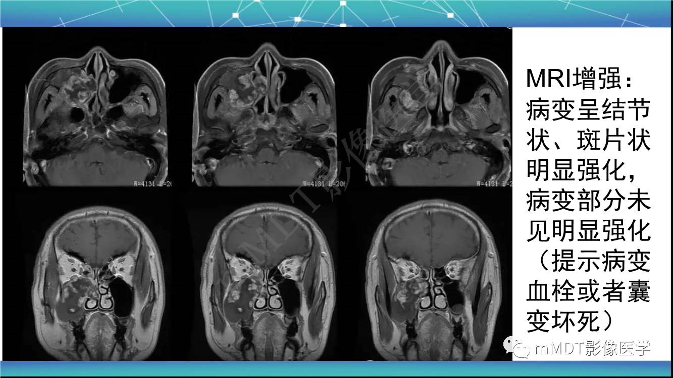 影像PPT - 【PPT】出血坏死性鼻息肉CT/MRI诊断-11