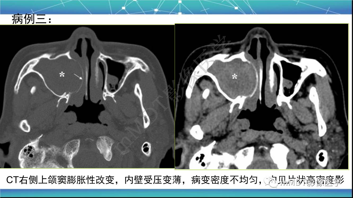 影像PPT - 【PPT】出血坏死性鼻息肉CT/MRI诊断-12